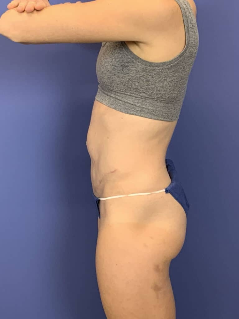 After Image:  - left-side