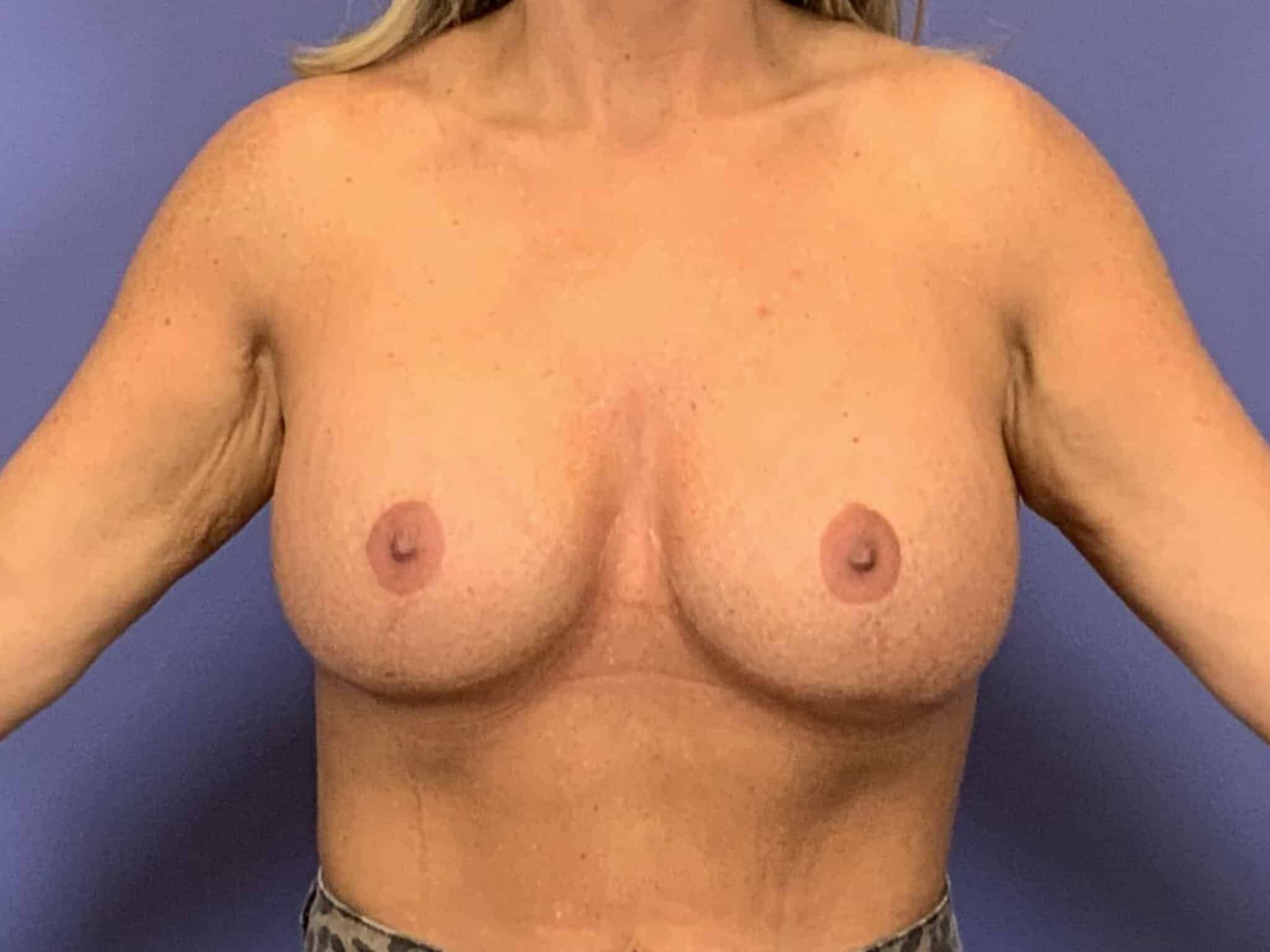 After Image:  - front
