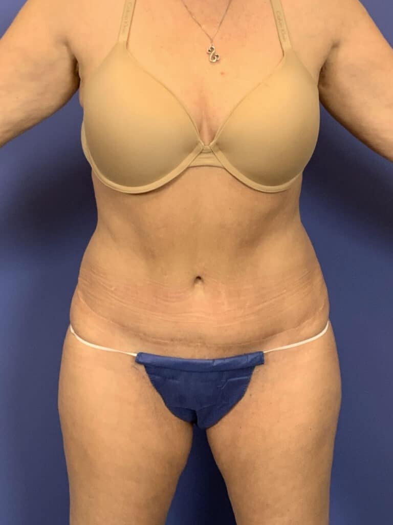 After Image:  - front