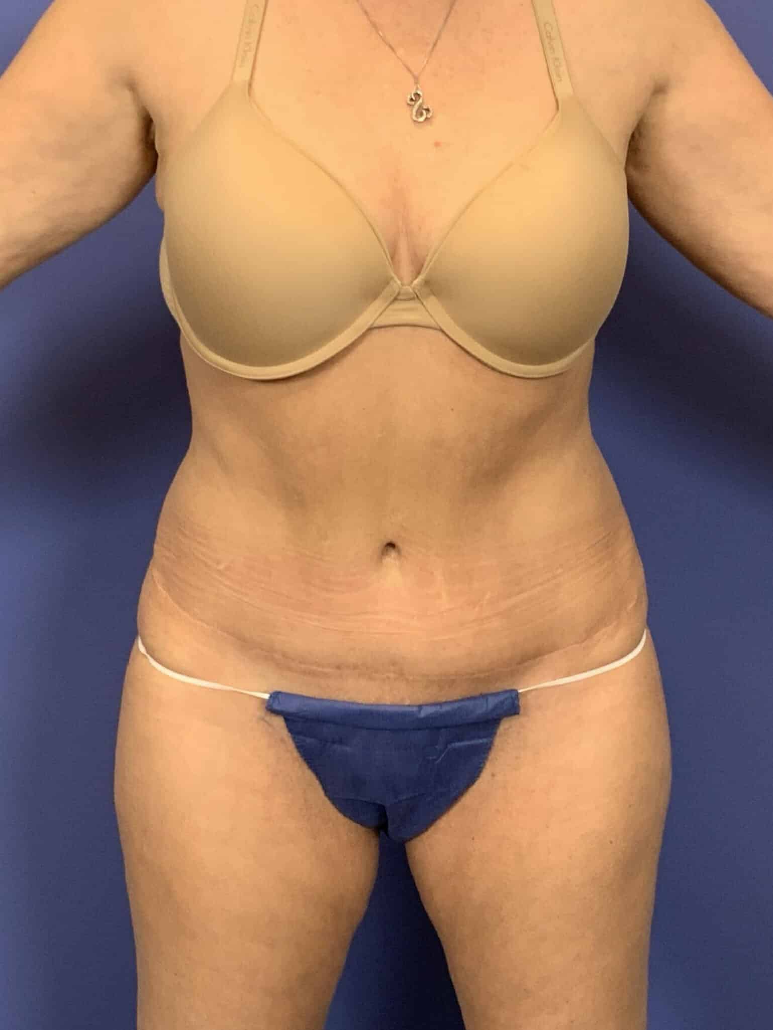 After Image:  - front