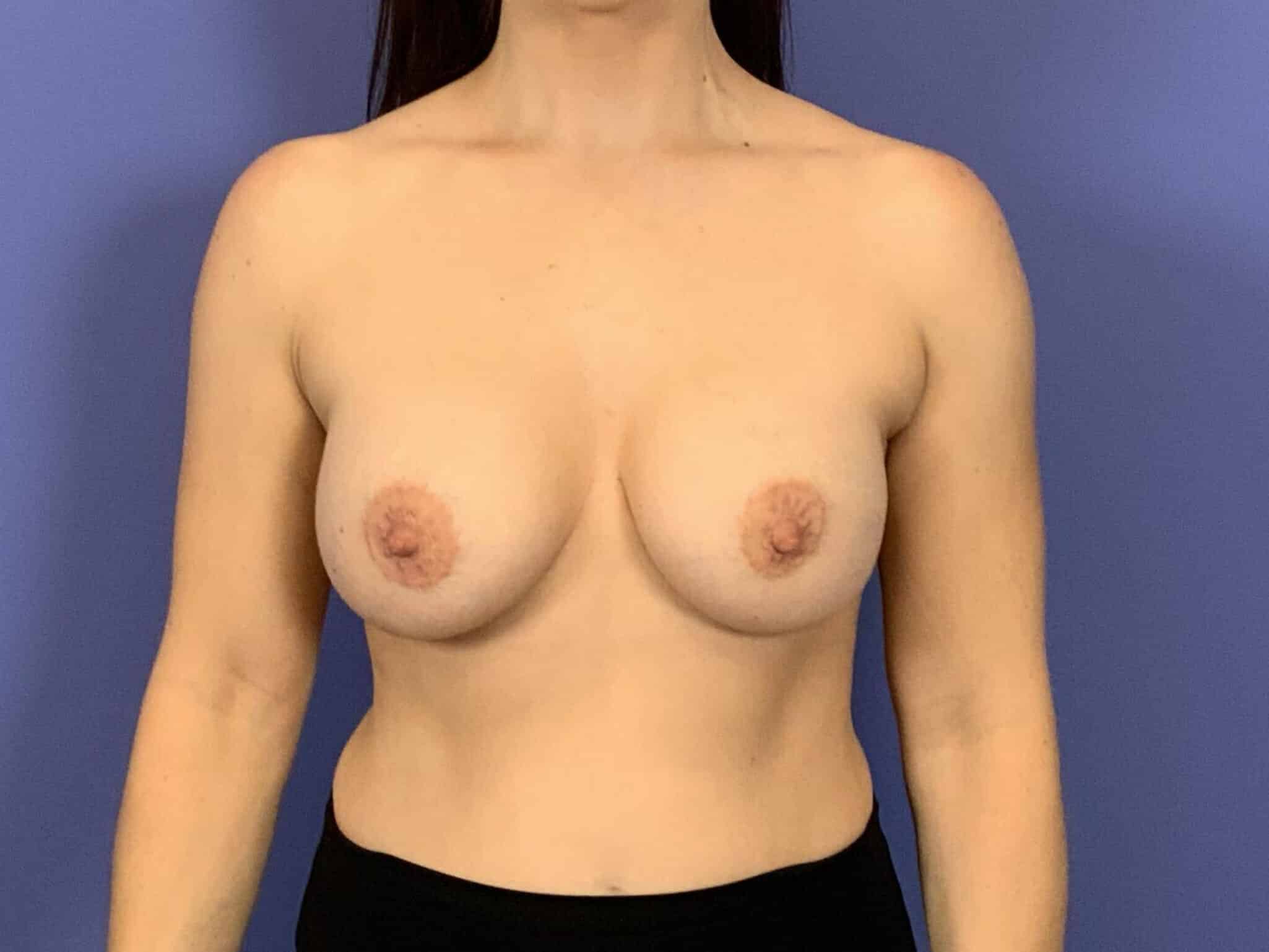 After Image:  - front