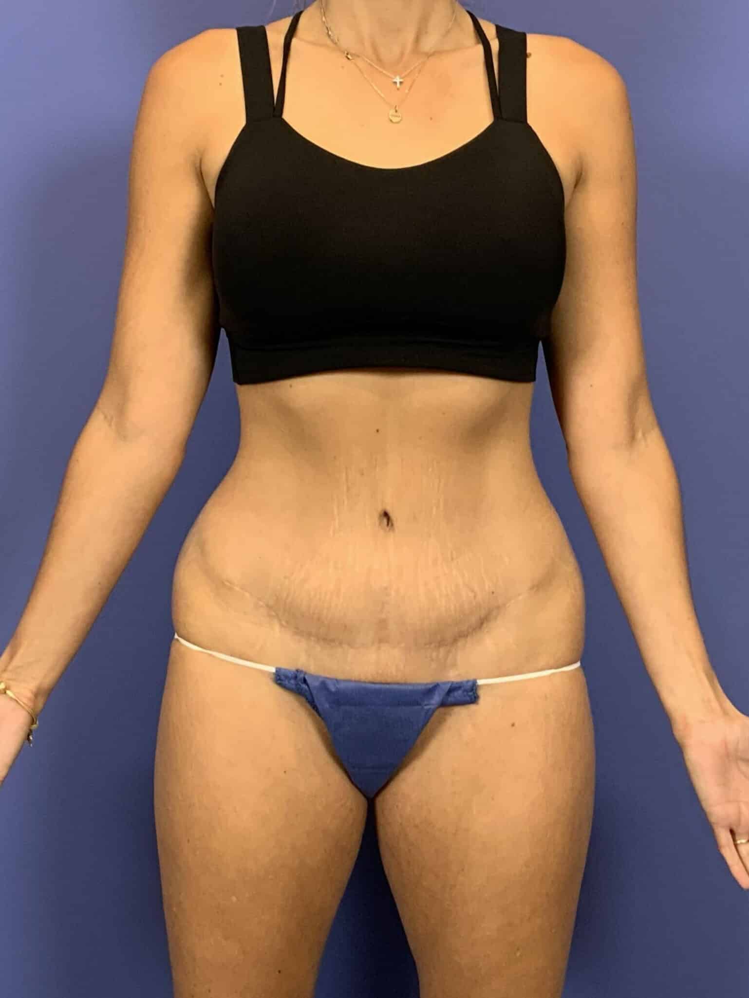 After Image:  - front