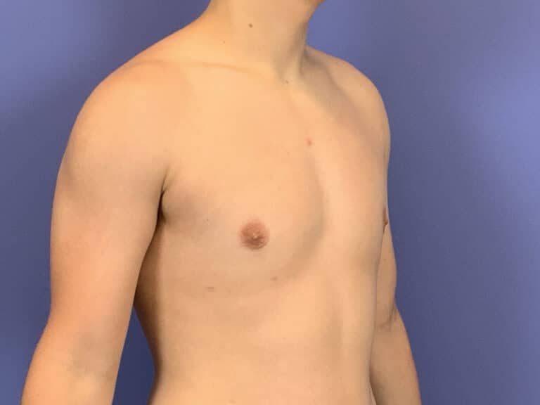After Image:  - left-front-oblique