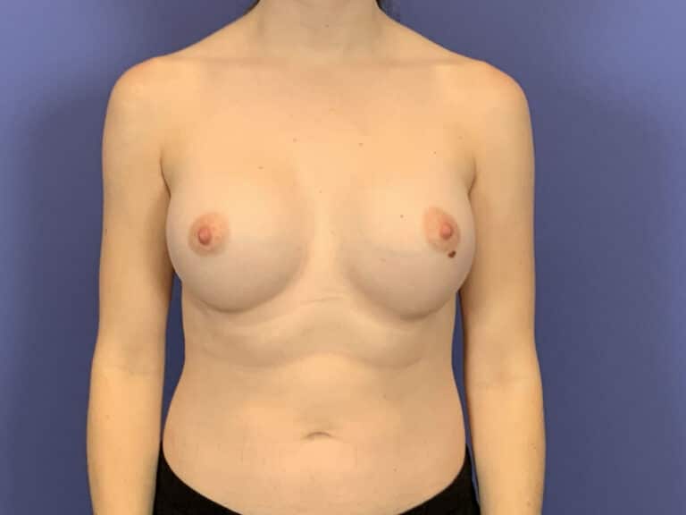 After Image:  - front