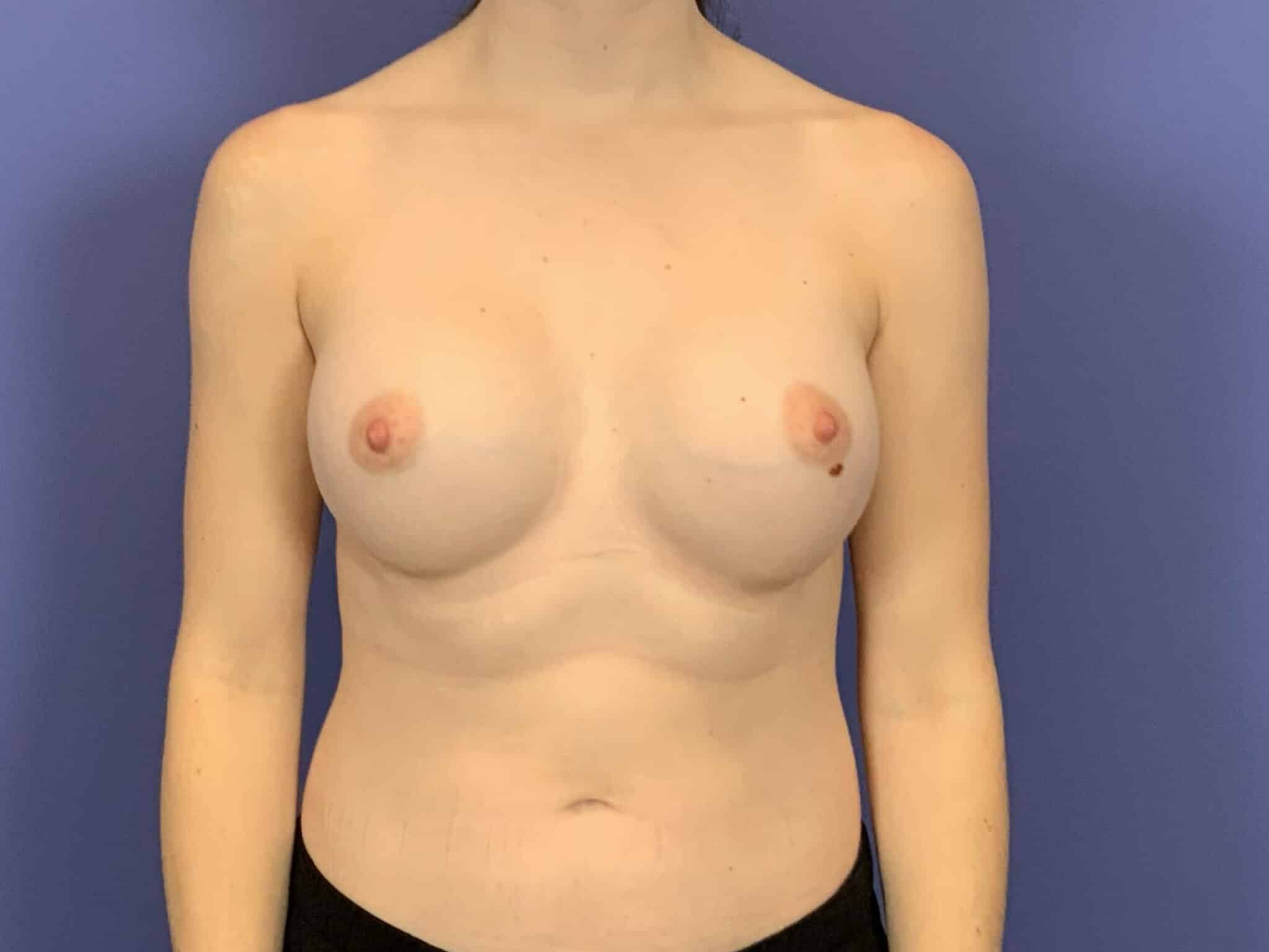 After Image:  - front