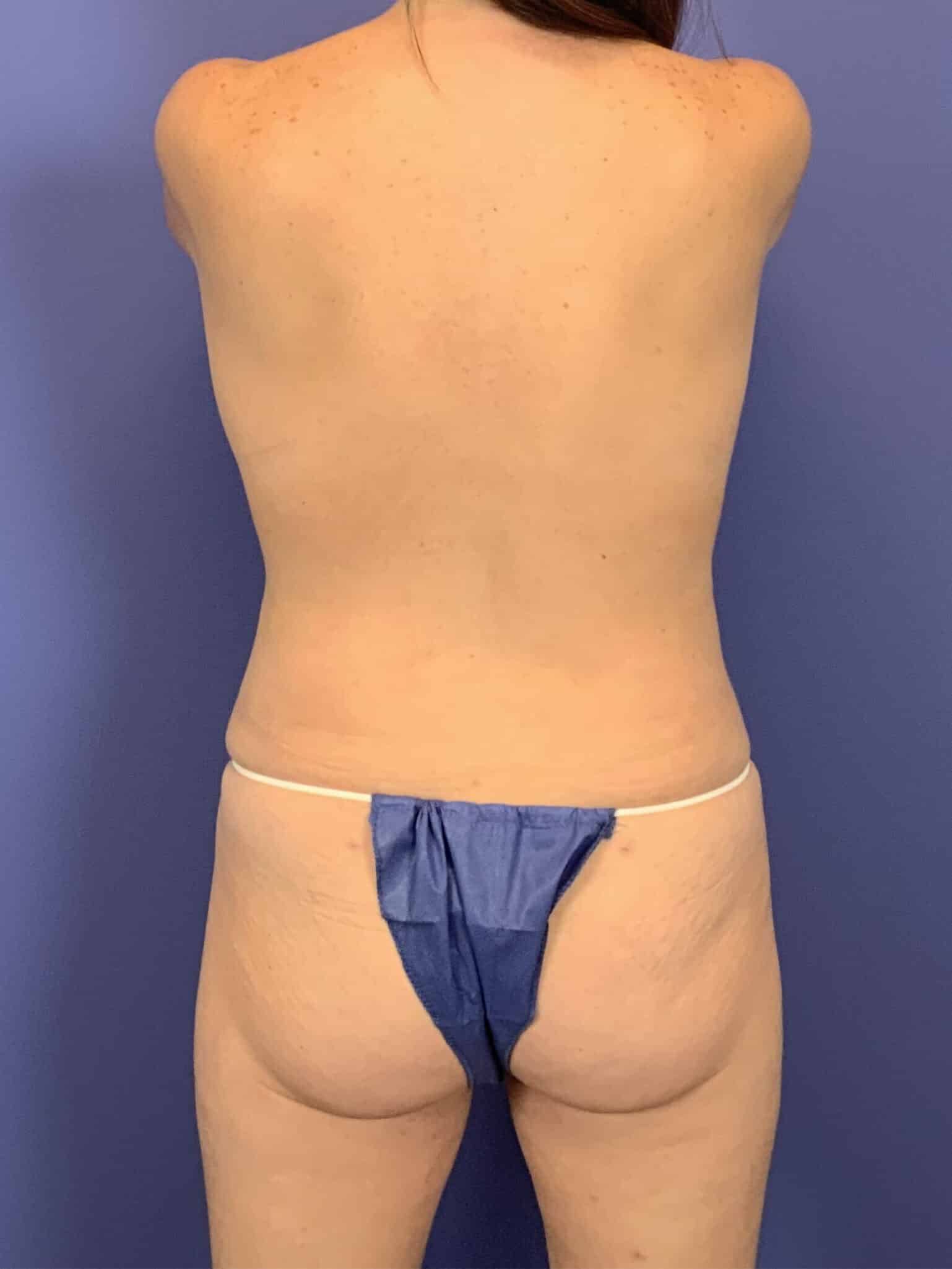 After Image:  - front
