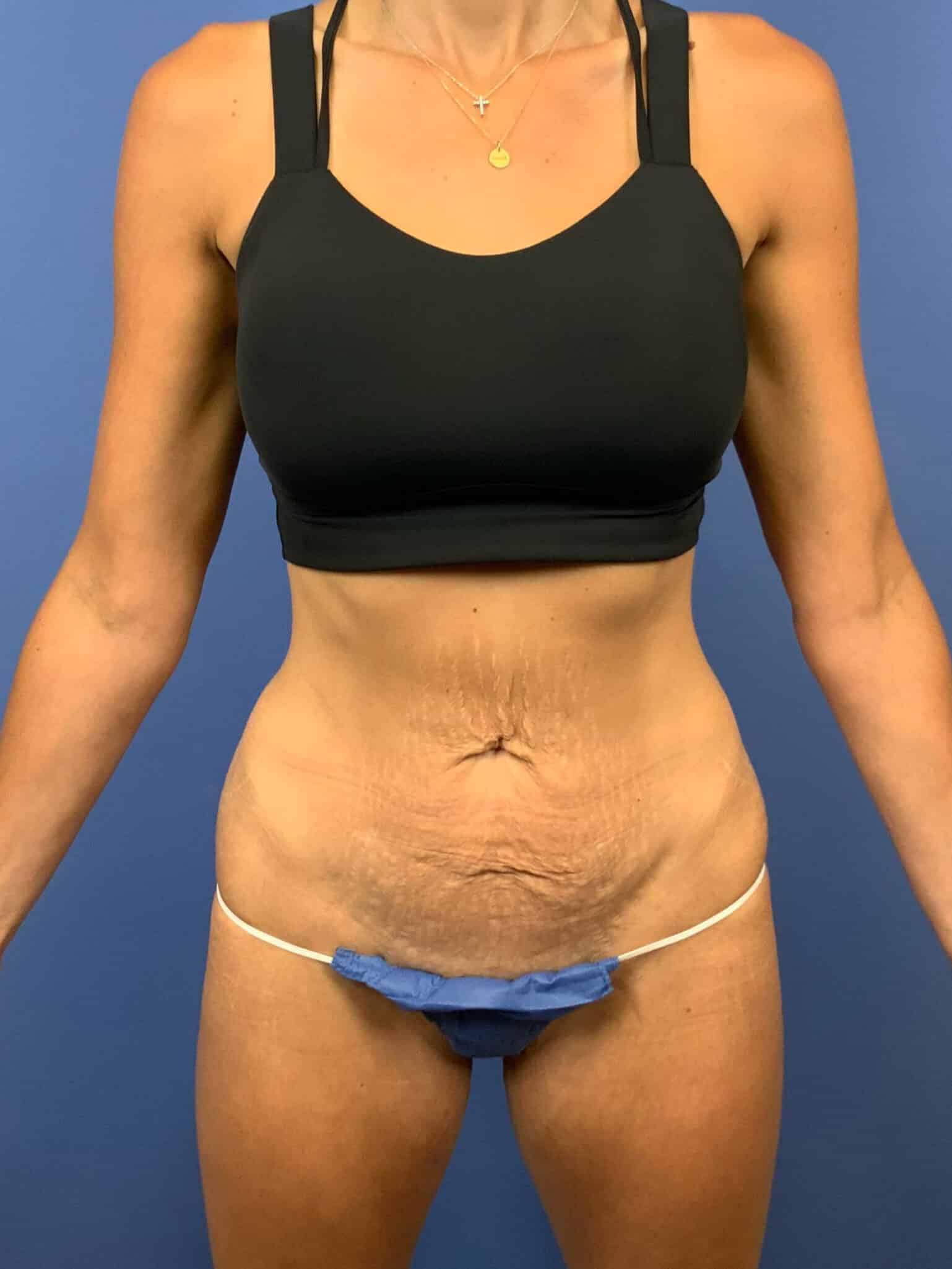 Before Image:  - front