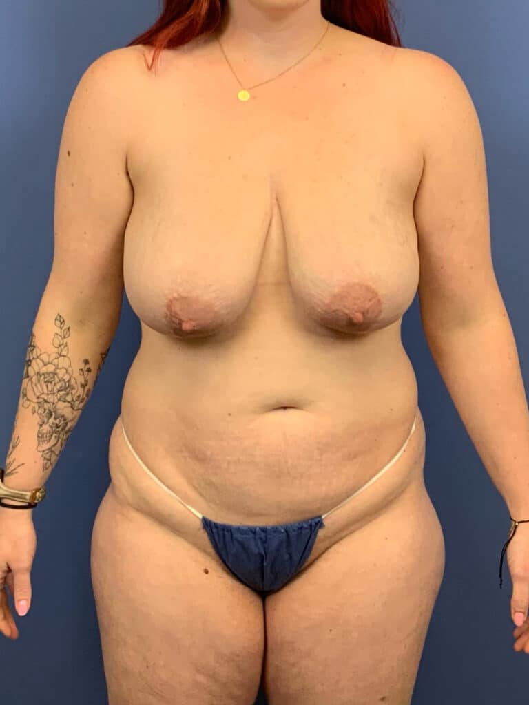 Before Image:  - front