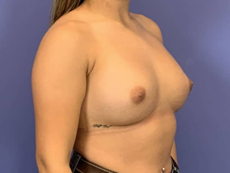 After Image:  - right-front-oblique