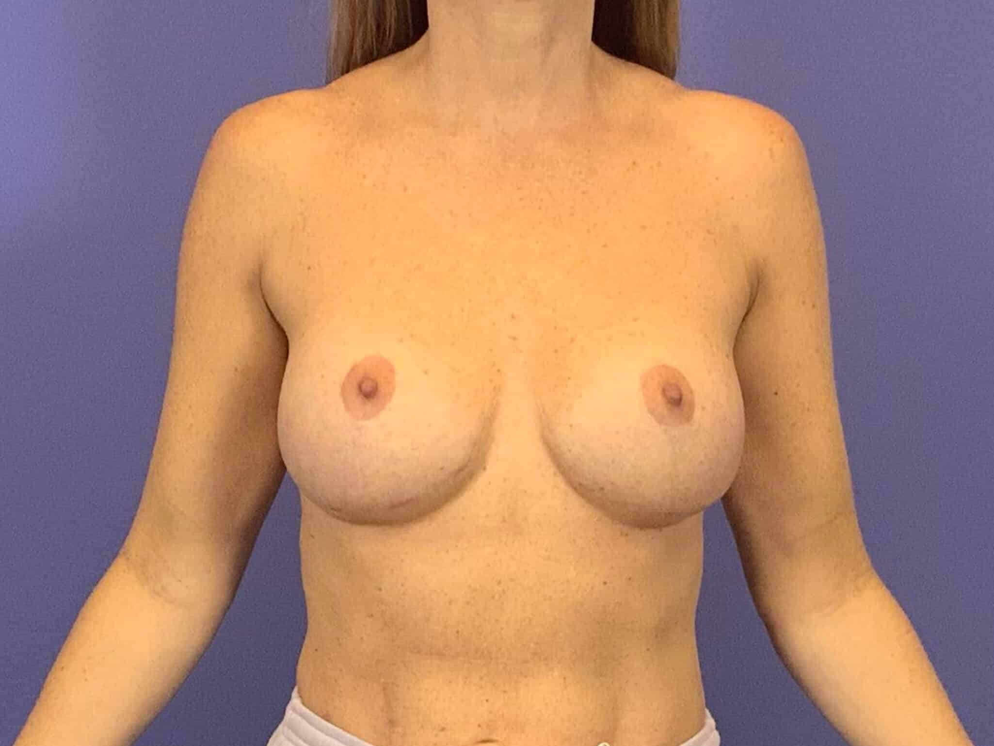 After Image:  - front