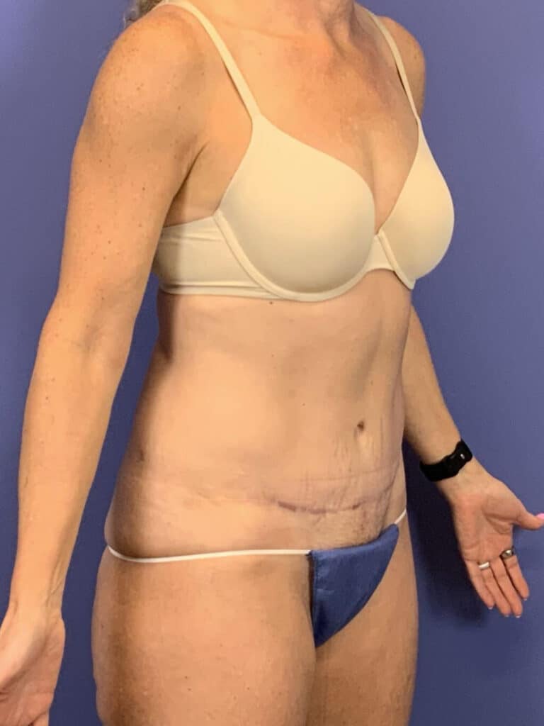 After Image:  - right-front-oblique