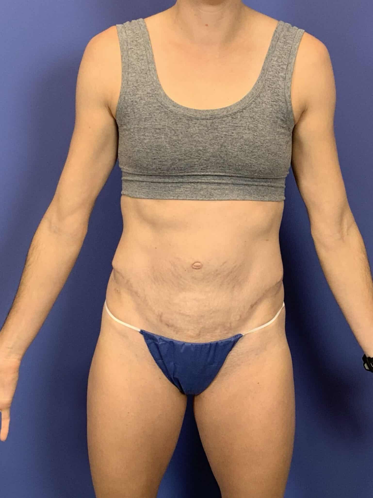 After Image:  - front