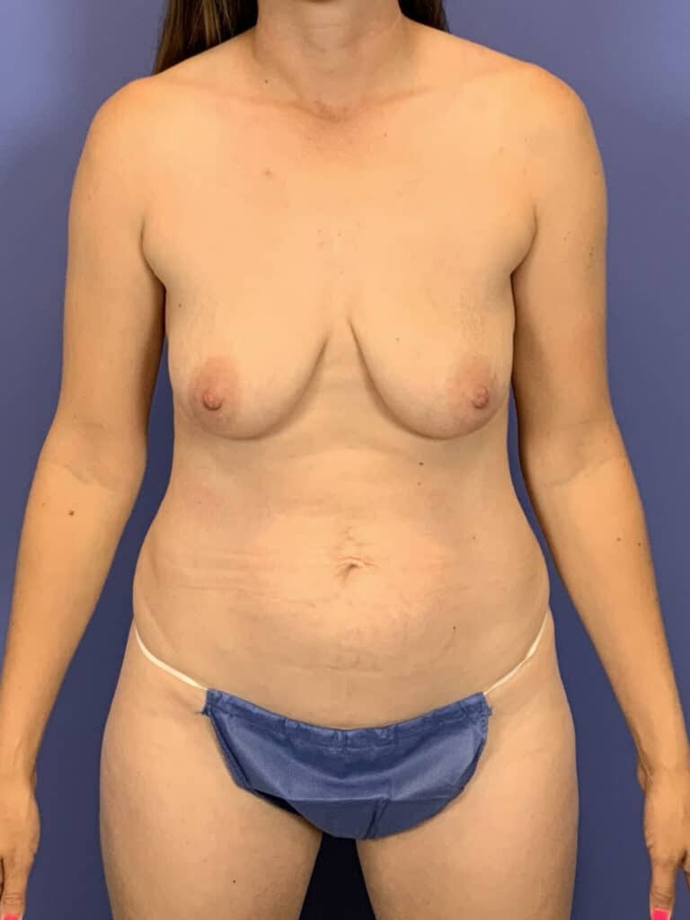 Before Image:  - front