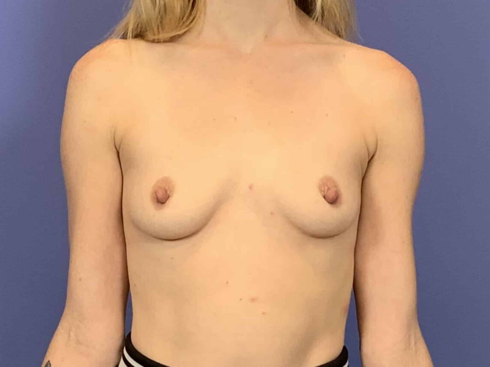 Before Image:  - front