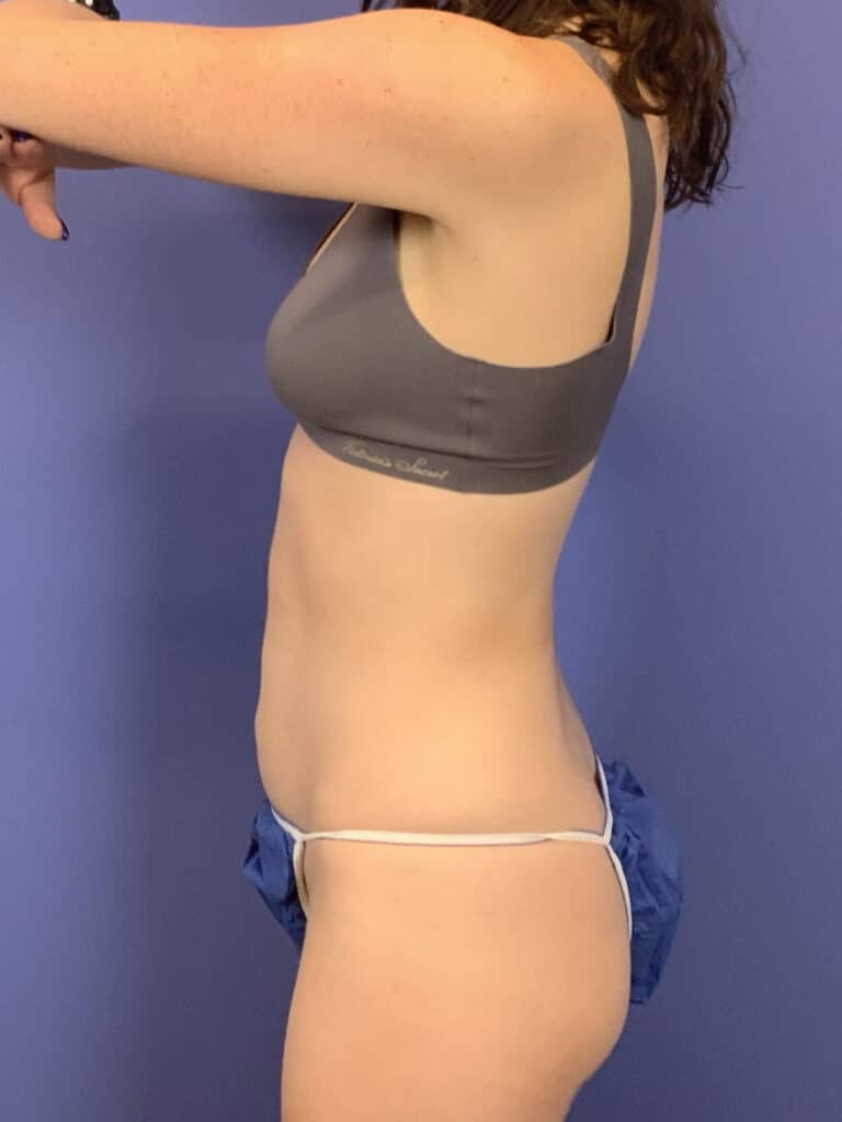 After Image:  - front