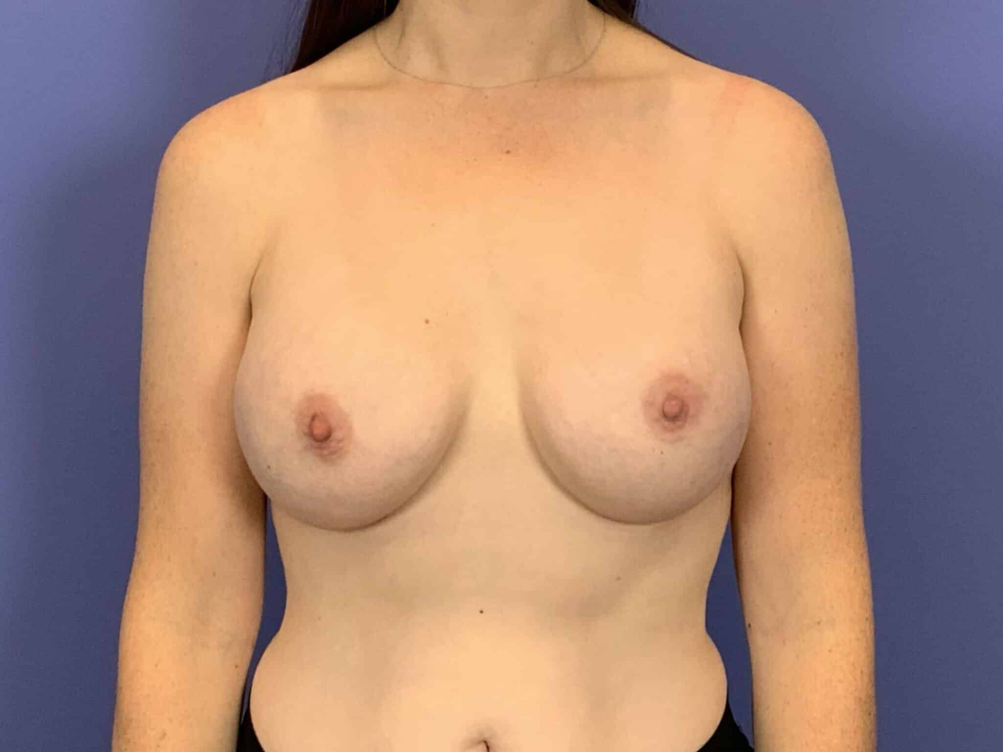 After Image:  - front