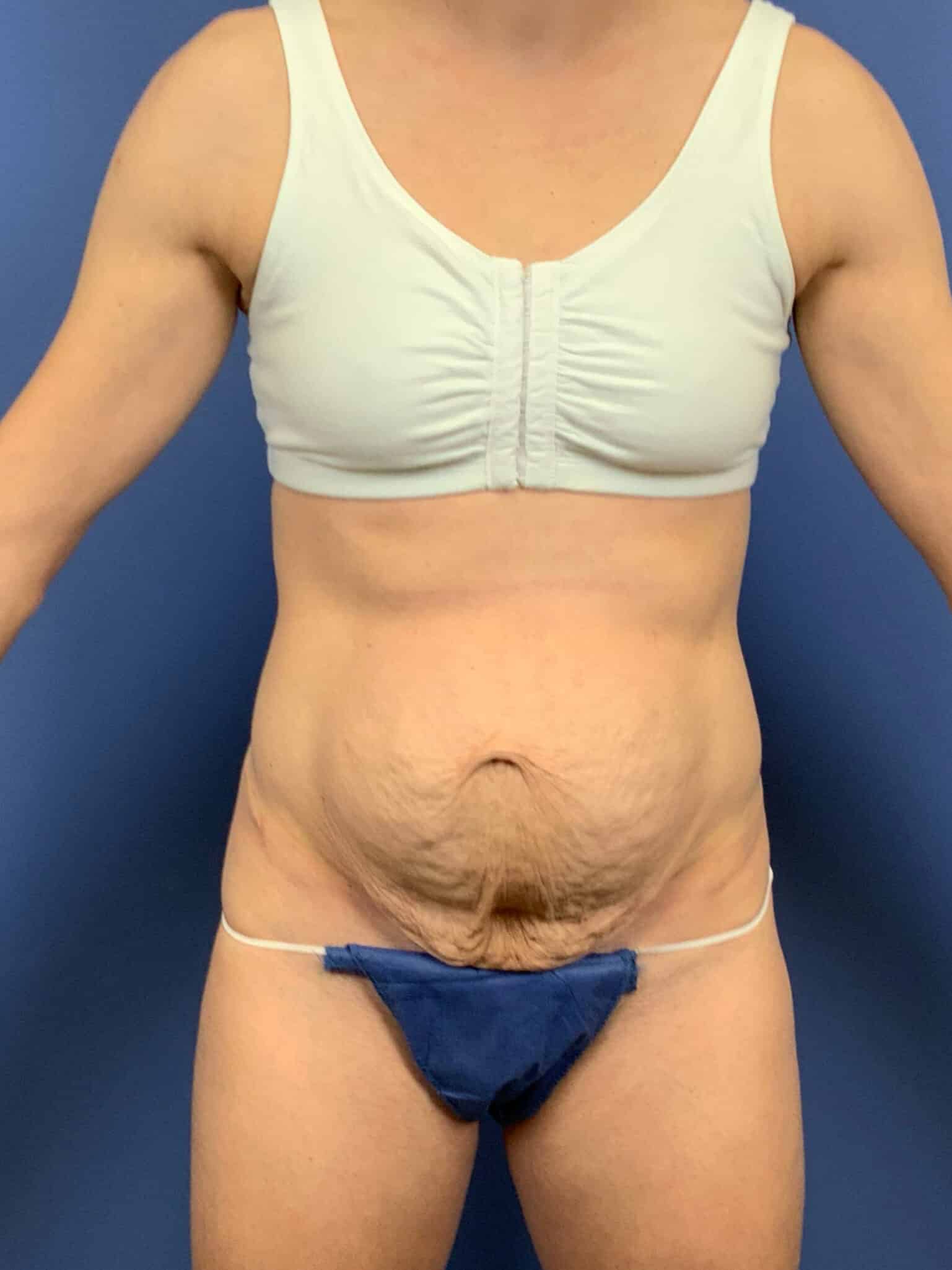 Before Image:  - front
