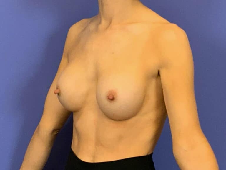 After Image:  - left-front-oblique
