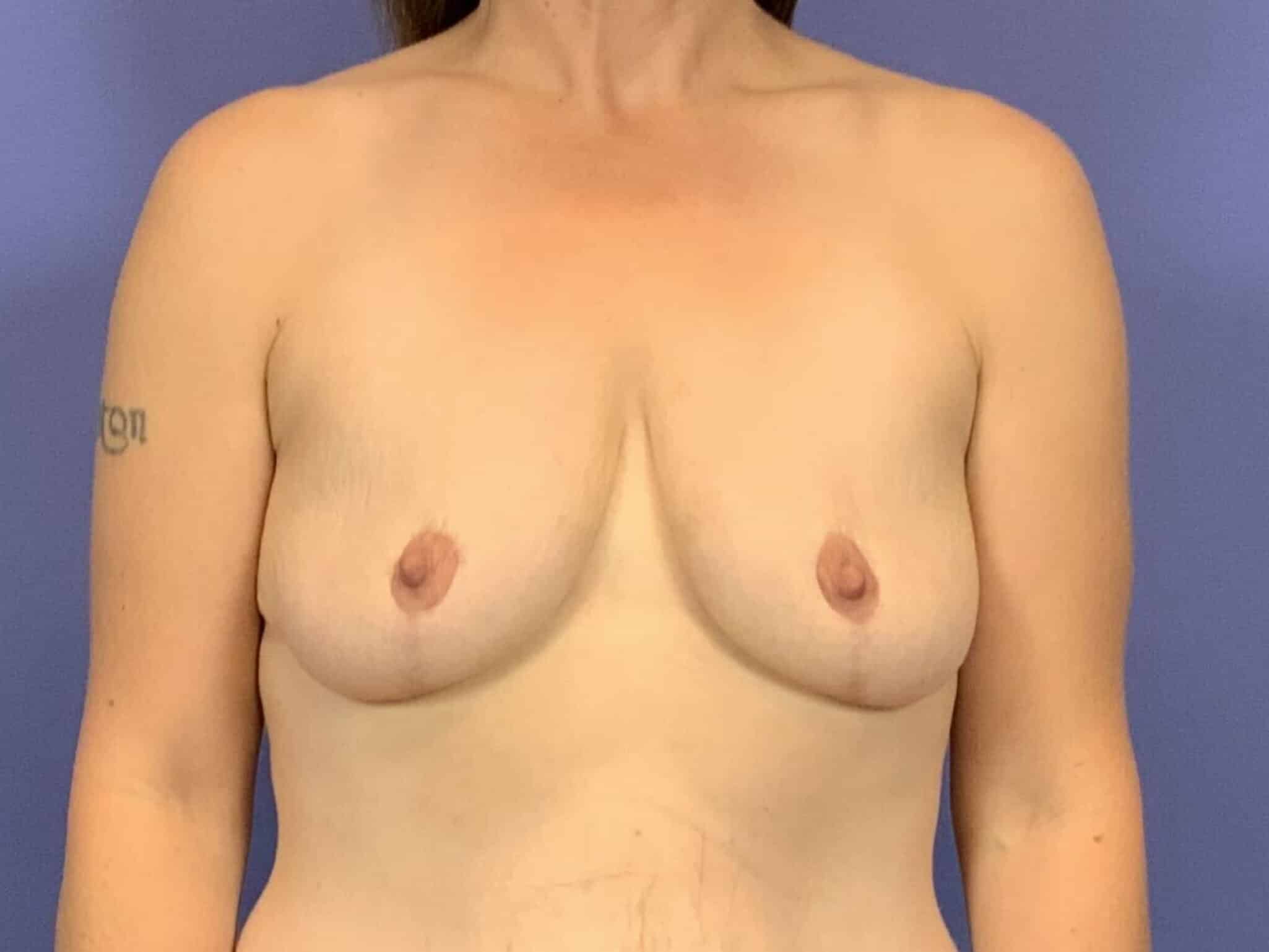 After Image:  - front