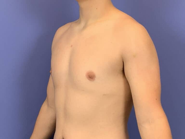 After Image:  - left-front-oblique
