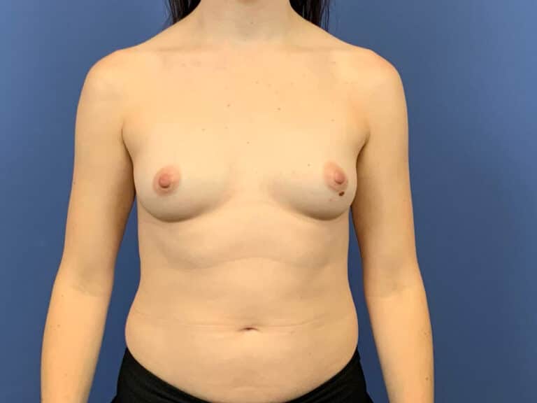 Before Image:  - front