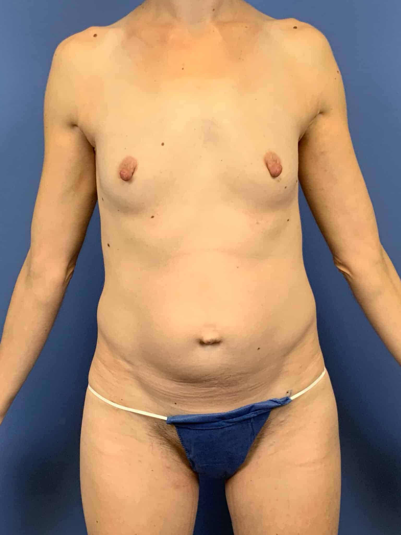 Before Image:  - front