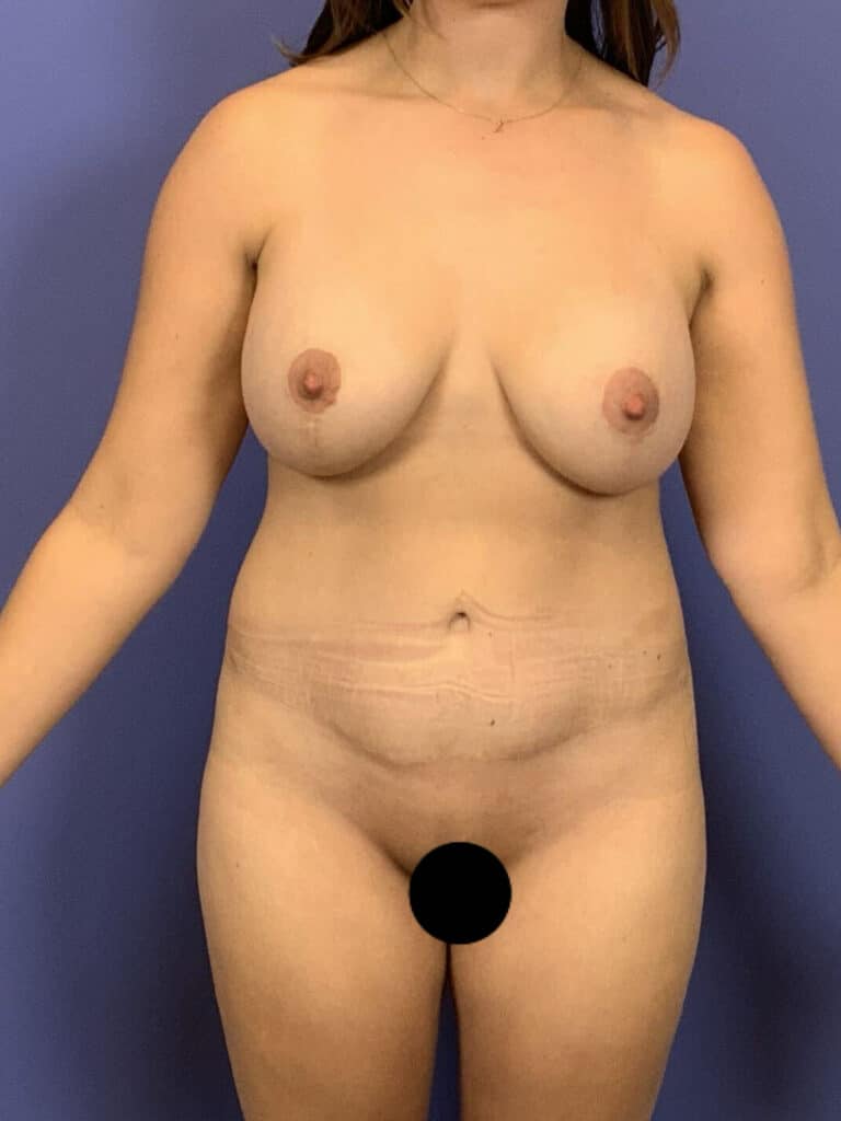 After Image:  - front