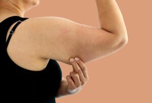 Woman pulling at loose skin on upper arm