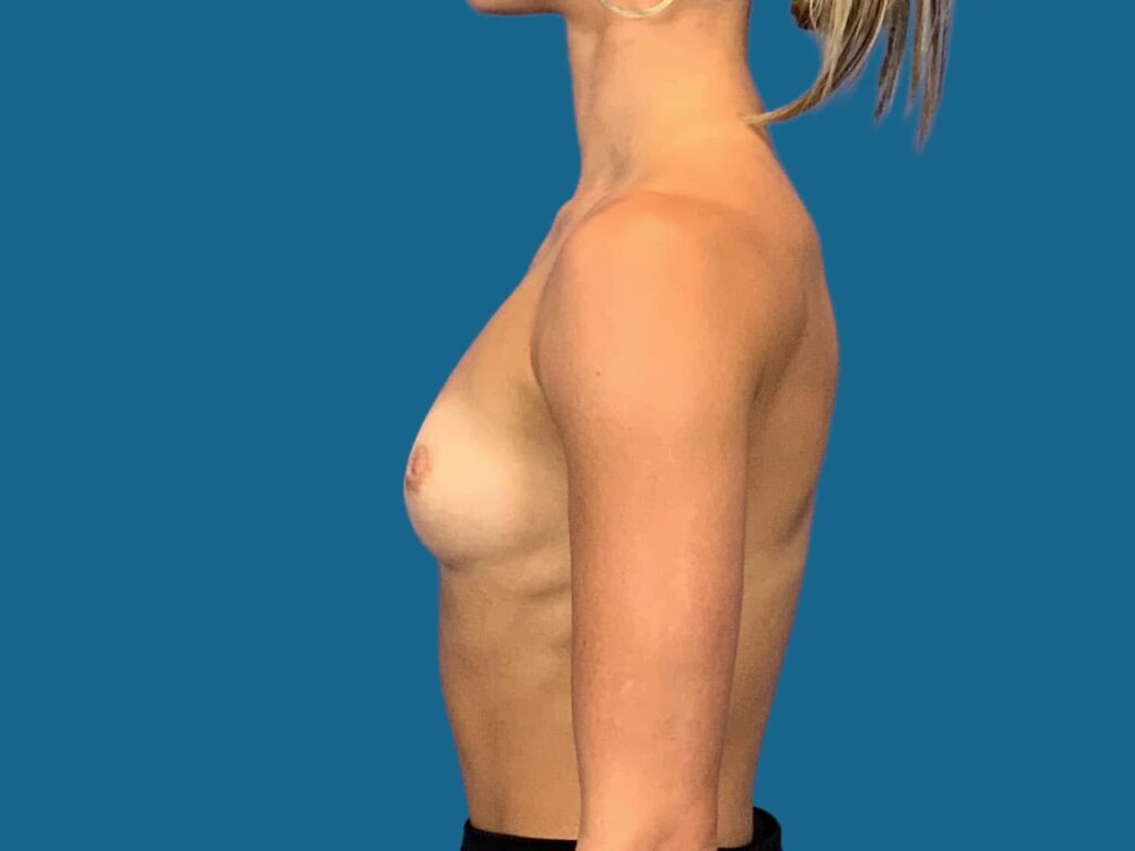 Before Image:  - left-side
