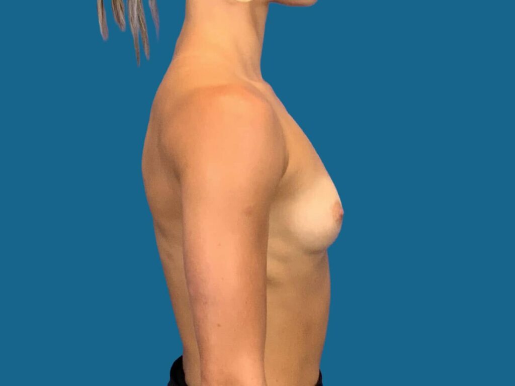 Before Image:  - right-side