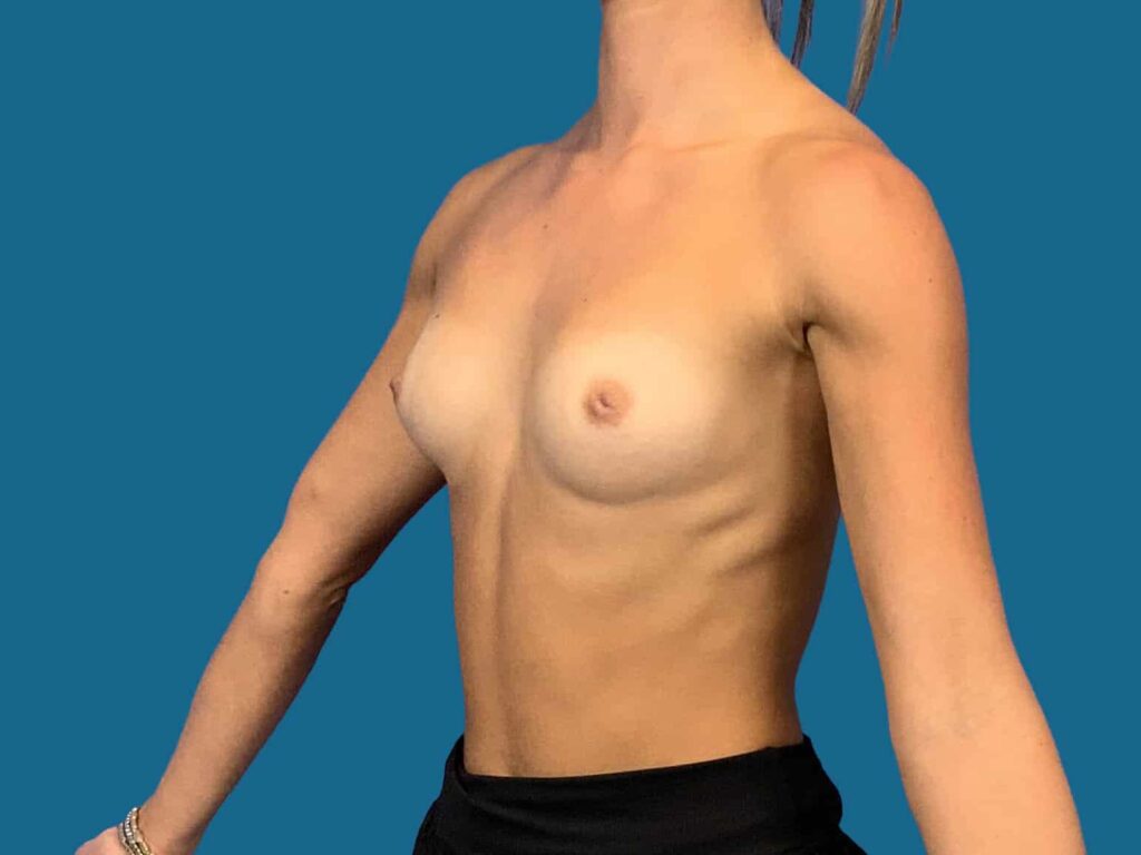 Before Image:  - left-front-oblique