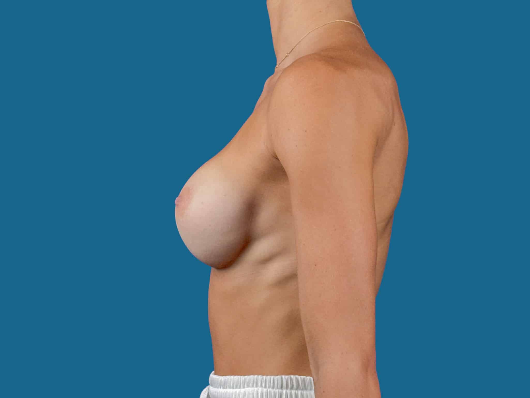 After Image:  - left-side