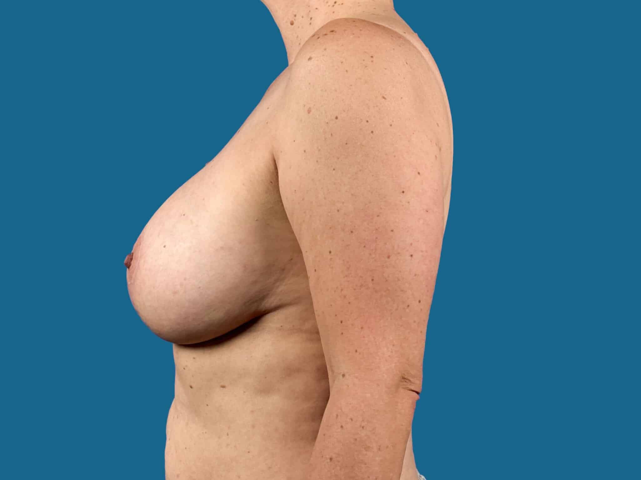 After Image:  - front