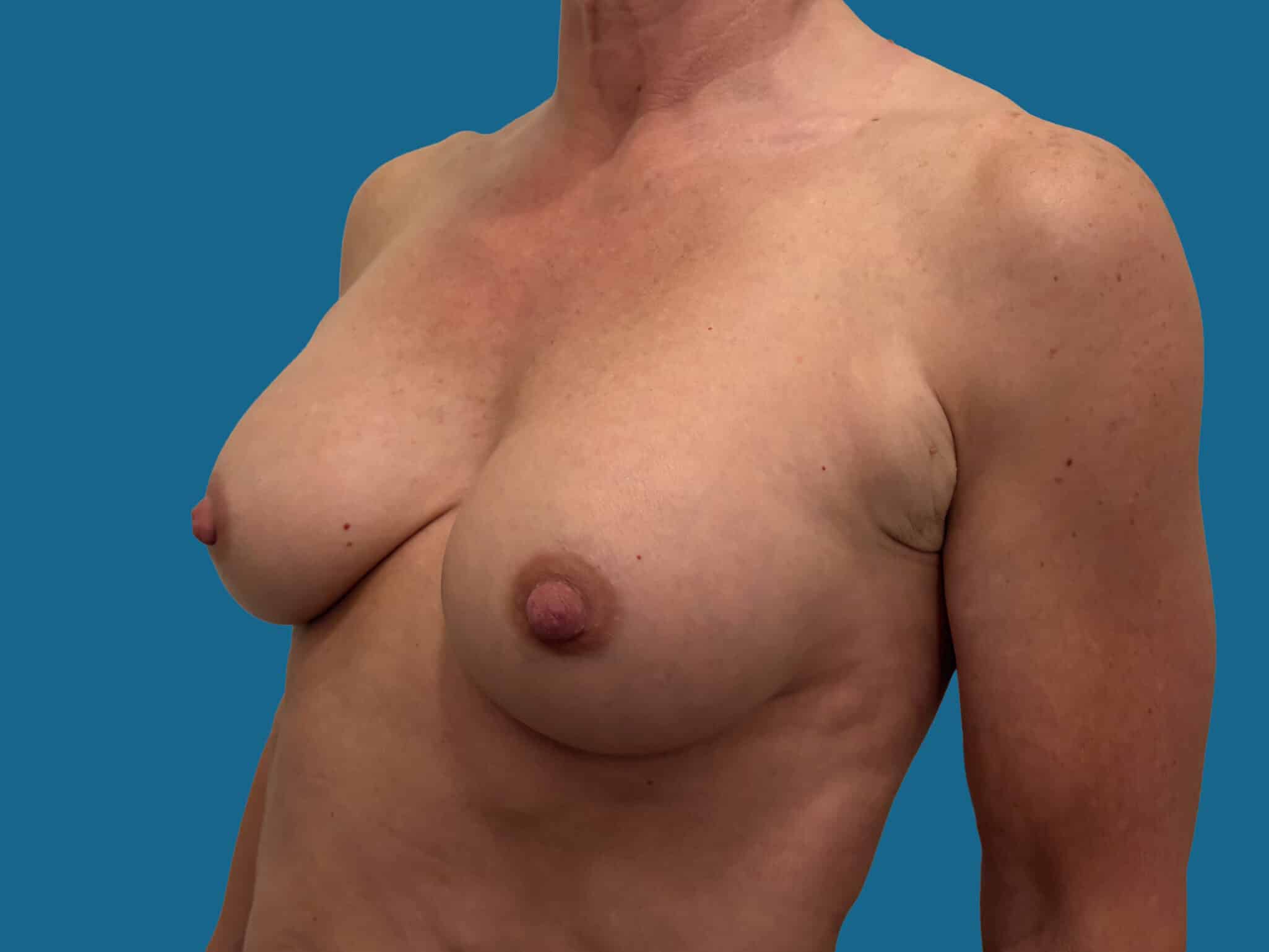 After Image:  - front