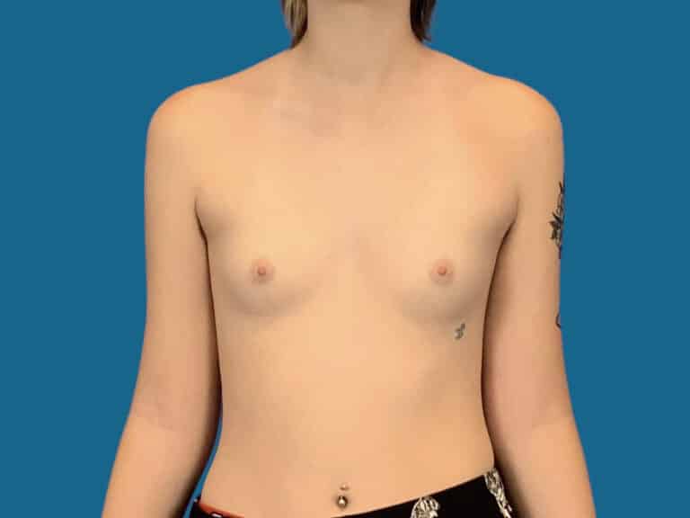 Before Image:  - front