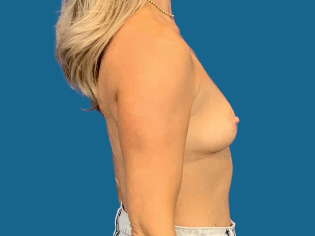 Before Image:  - front