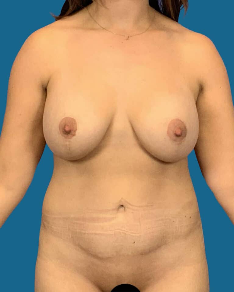 After Image:  - front