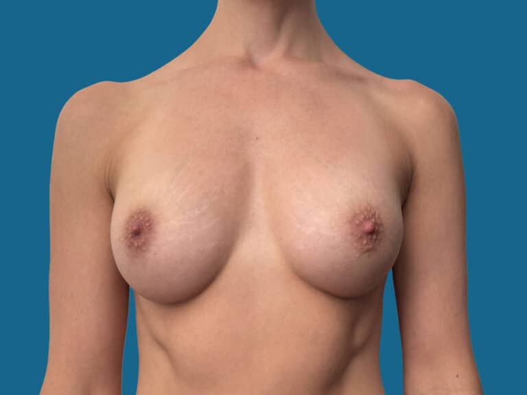 After Image:  - front