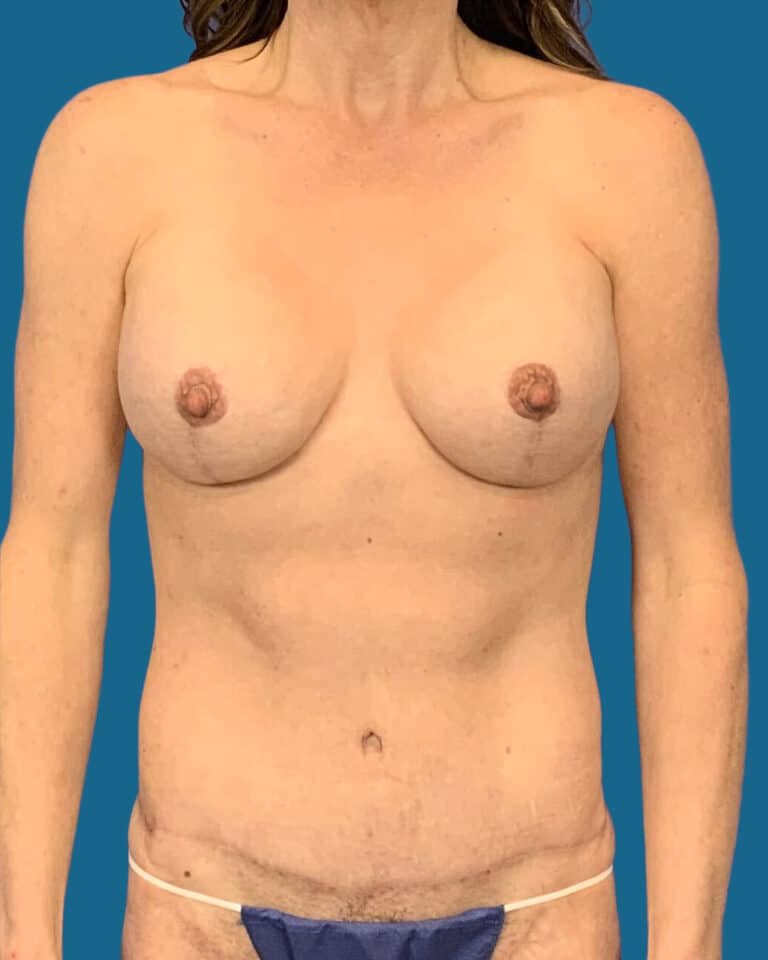 After Image:  - front