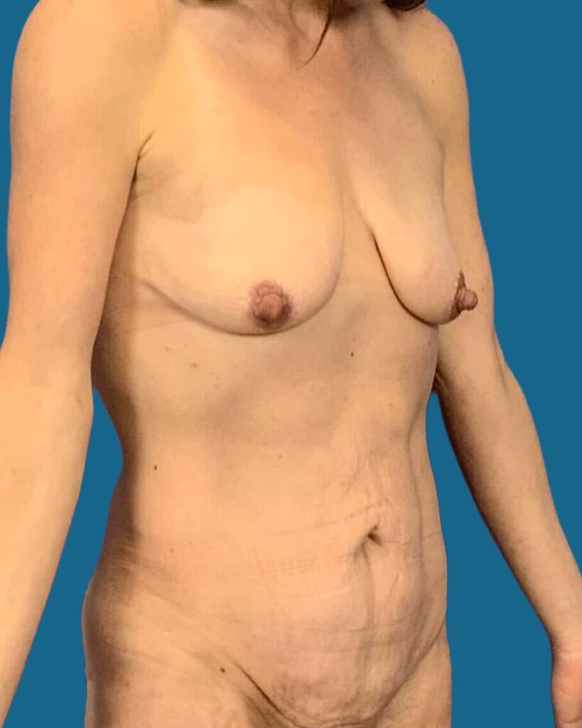 Before Image:  - front