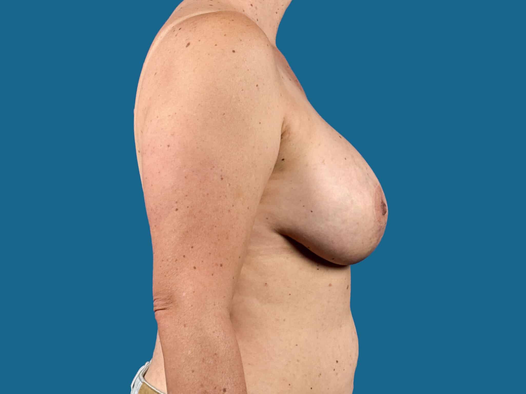 After Image:  - front
