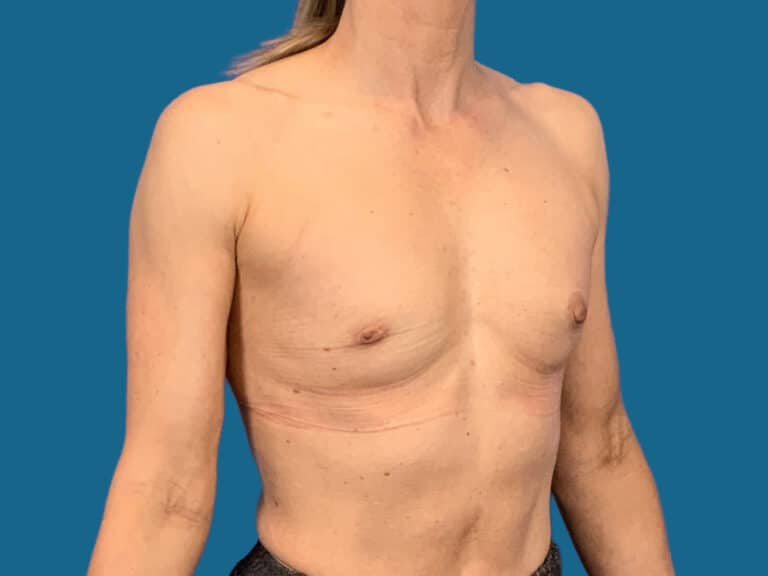Before Image:  - front