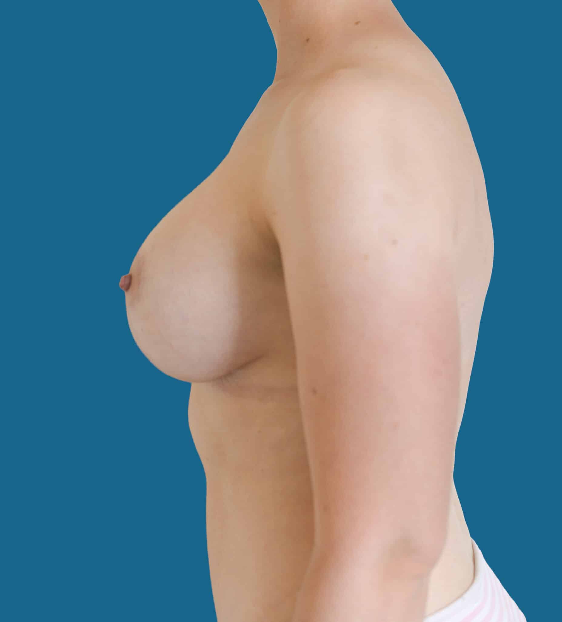 After Image:  - front