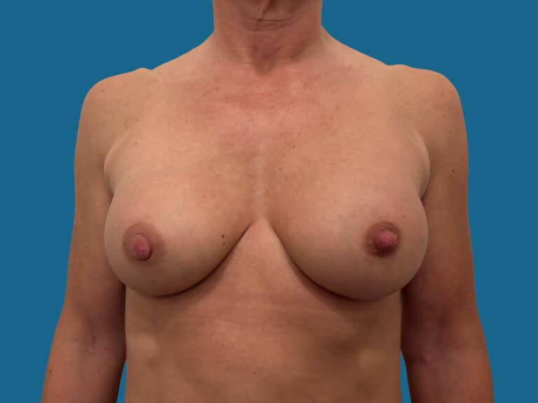 After Image:  - front