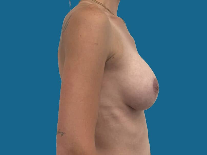 After Image:  - front