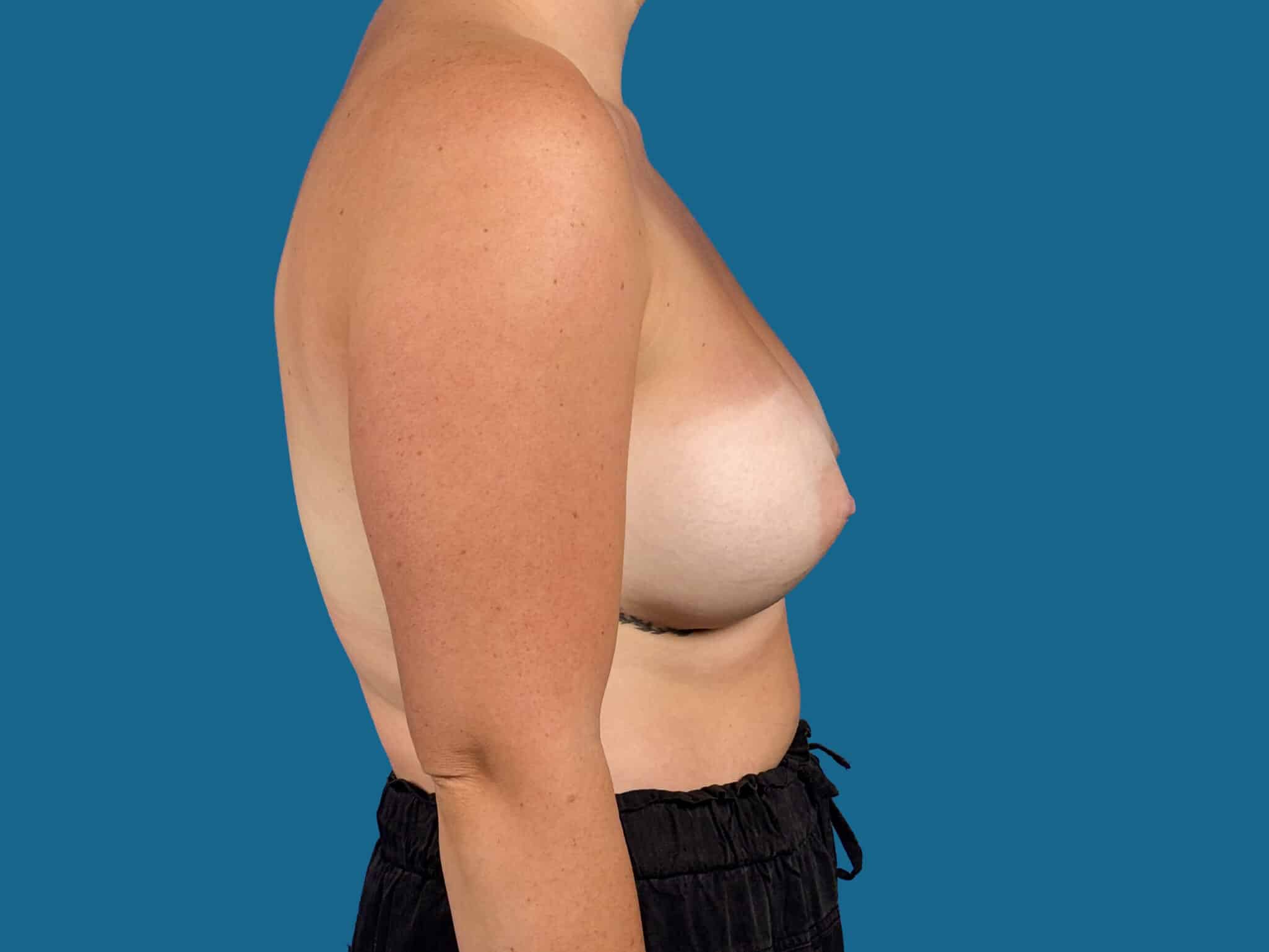 After Image:  - front