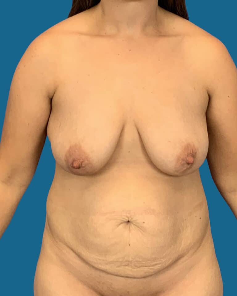 Before Image:  - front