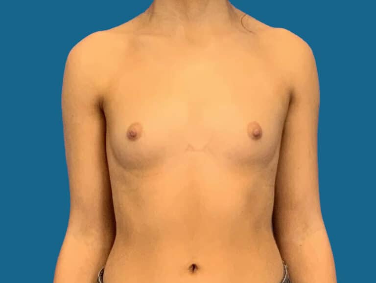 Before Image:  - front