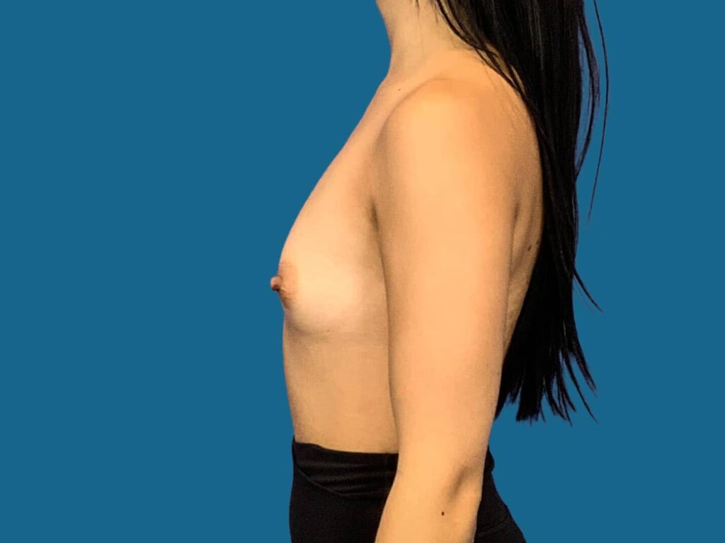 Before Image:  - left-side
