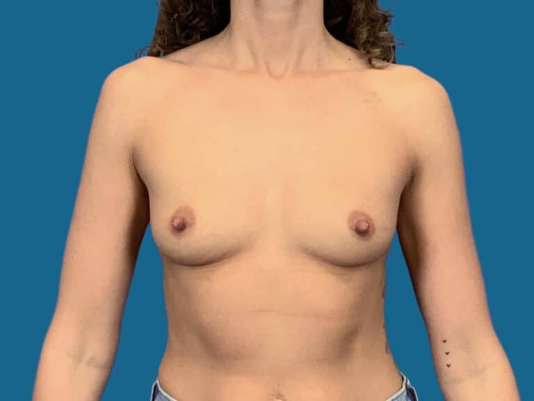 Before Image:  - front